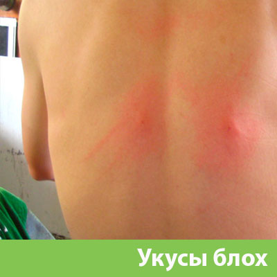 Укусы блох в Белгороде