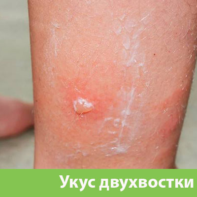 Укус двухвостки в Белгороде