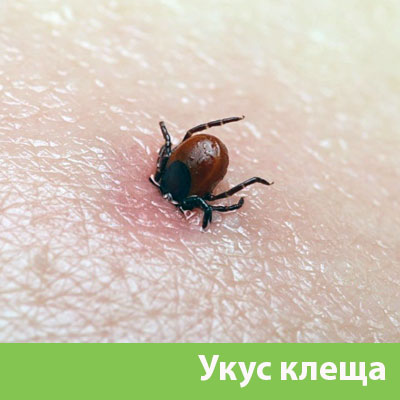 Укус клеща в Белгороде