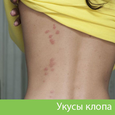 Профессиональное уничтожение клопов в Белгороде
